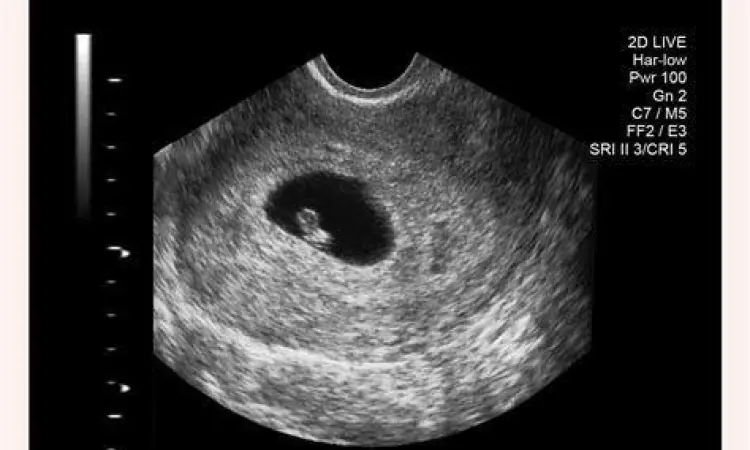 USG Kehamilan Dini Hasil pemeriksaan USG kantung kehamilan 5 minggu